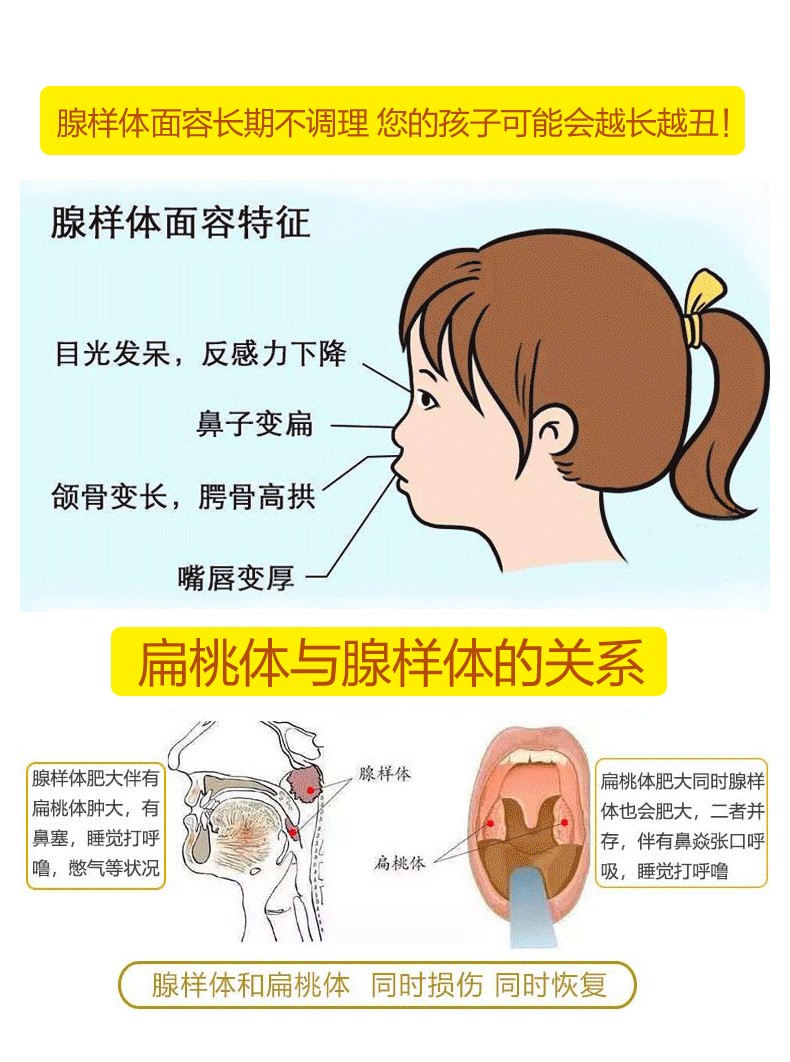 腺样体肥大 鼻炎喷剂 成人儿童过敏性鼻炎 儿童宝宝鼻塞通气鼻贴 棉签