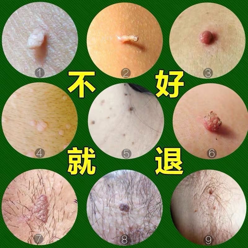 【京东健康大药房】一擦就掉】瘊子肉刺扁平尤无痛去脖子小肉粒丝状尤