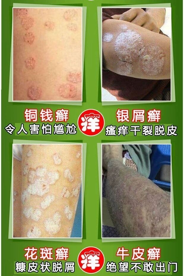 【京东药房直发】牛皮癣银屑病专用苗特效止痒药膏皮肤瘙痒外用治神经