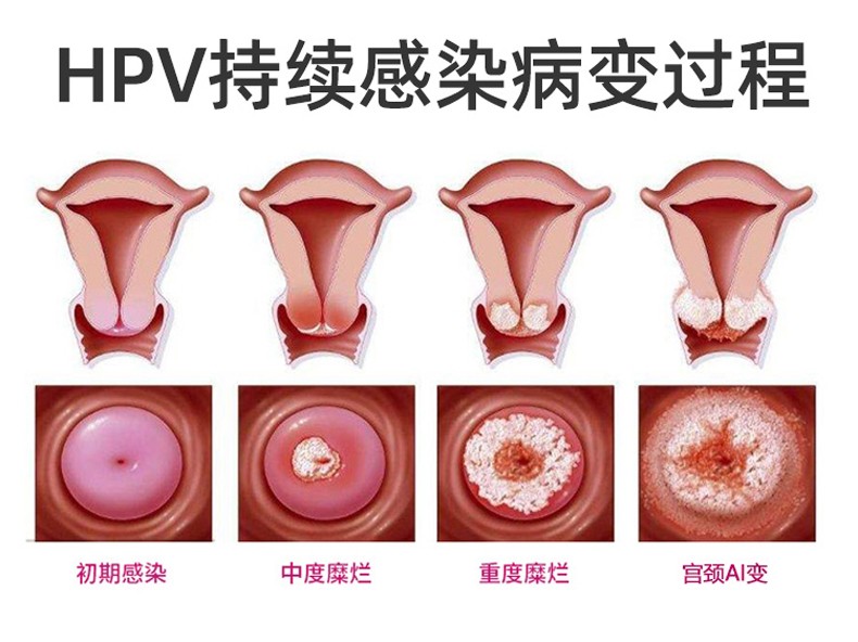 hpv病毒凝胶阻断高危型hpv感染预防宫颈病变高危感染生物蛋白敷料抑菌