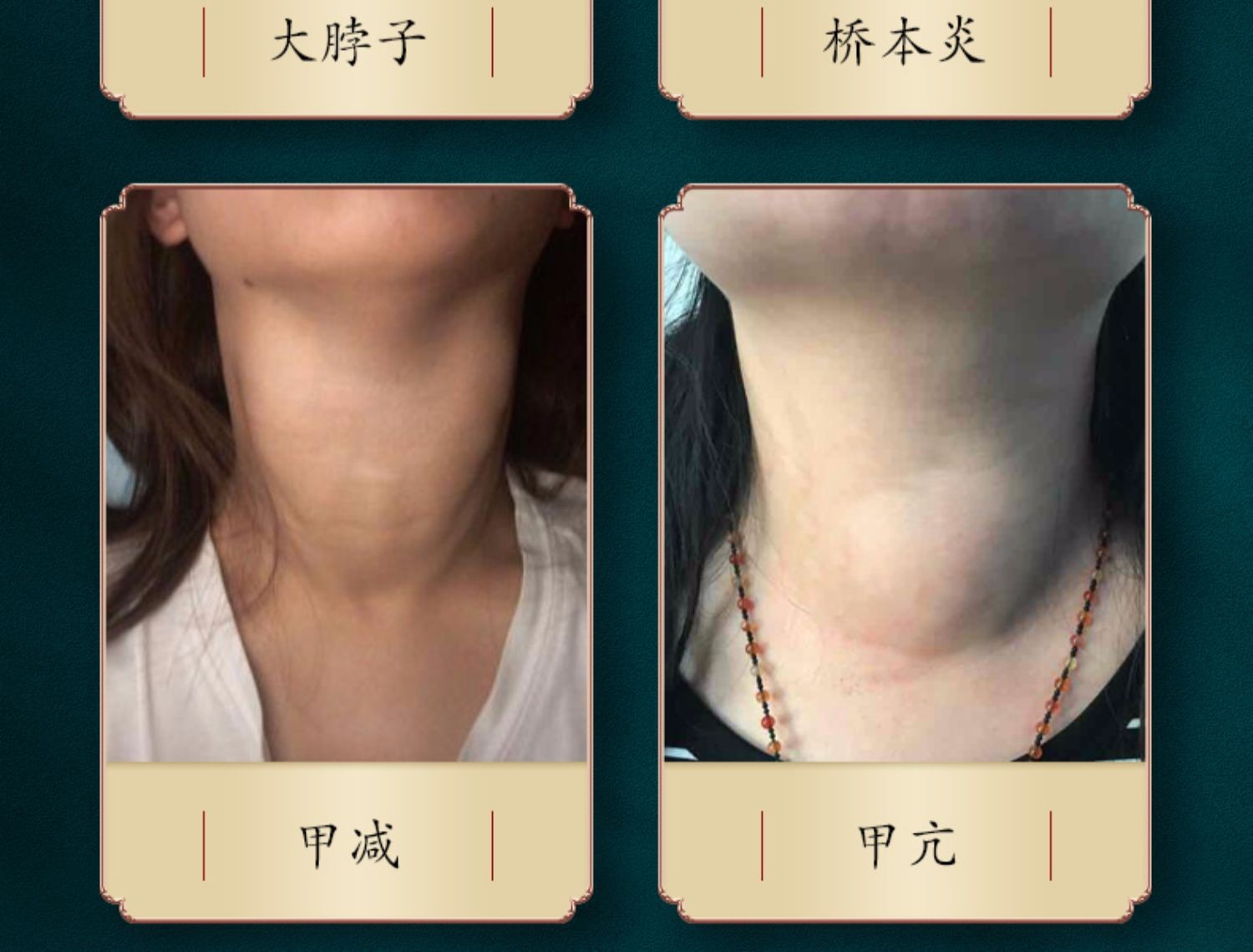 甲状腺结节散结贴甲状腺贴医用冷敷贴甲状腺肿大淋巴结肿大咽喉肿痛