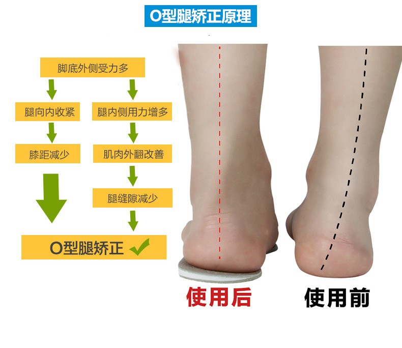 o型腿型矫正外八字脚偏矫正器脚跟足内翻磨鞋底o形腿外高内低鞋垫e08