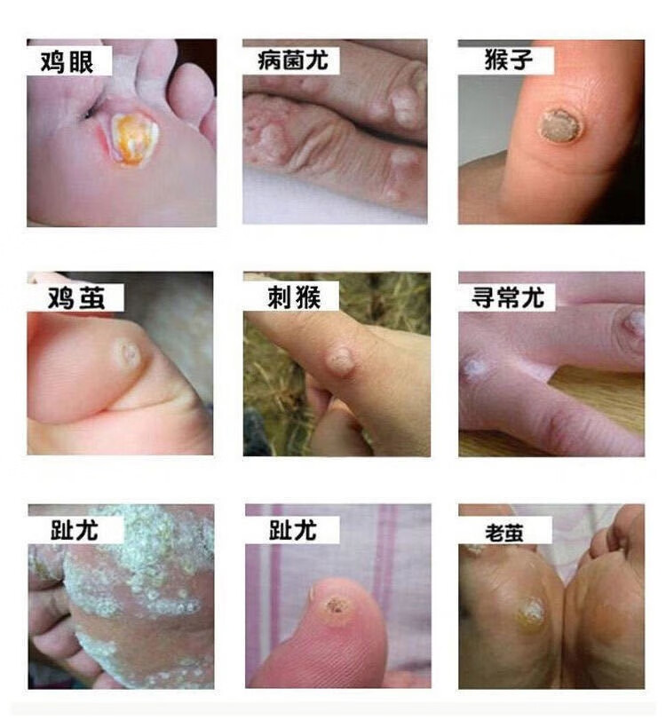 【当天鸡眼掉】去鸡眼药水抑菌液去脚趾手指鸡眼肉刺顽固除反复鸡眼膏
