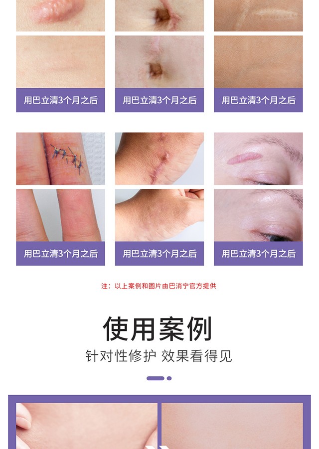 药房直售顺宁堂巴立清硅酮凝胶膏修复疤痕手术烫烧伤疤痕疤力轻硅酮