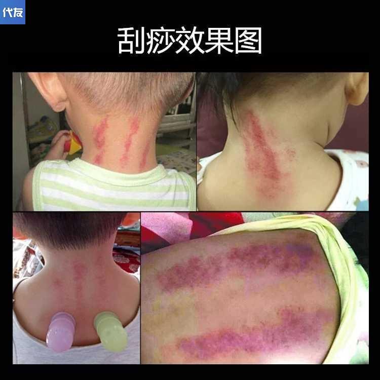 易罐美容罐面部硅胶拔罐益罐小儿推拿刮痧拔罐儿童橡胶皮罐家用买二送