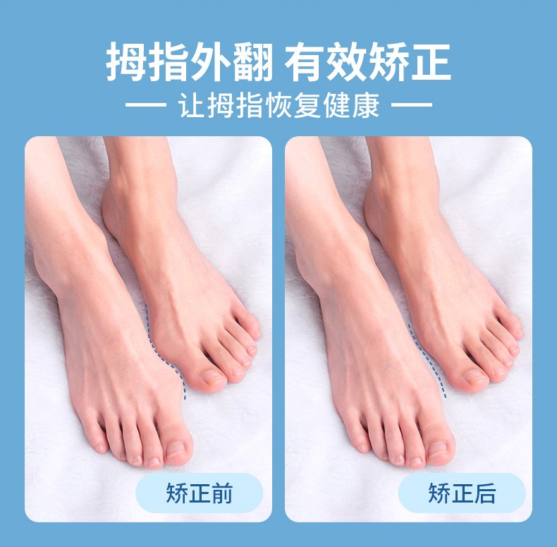 夏季可用盛坤姆外翻矫正器脚趾矫正器大拇指外翻大脚骨脚指头分趾纠正