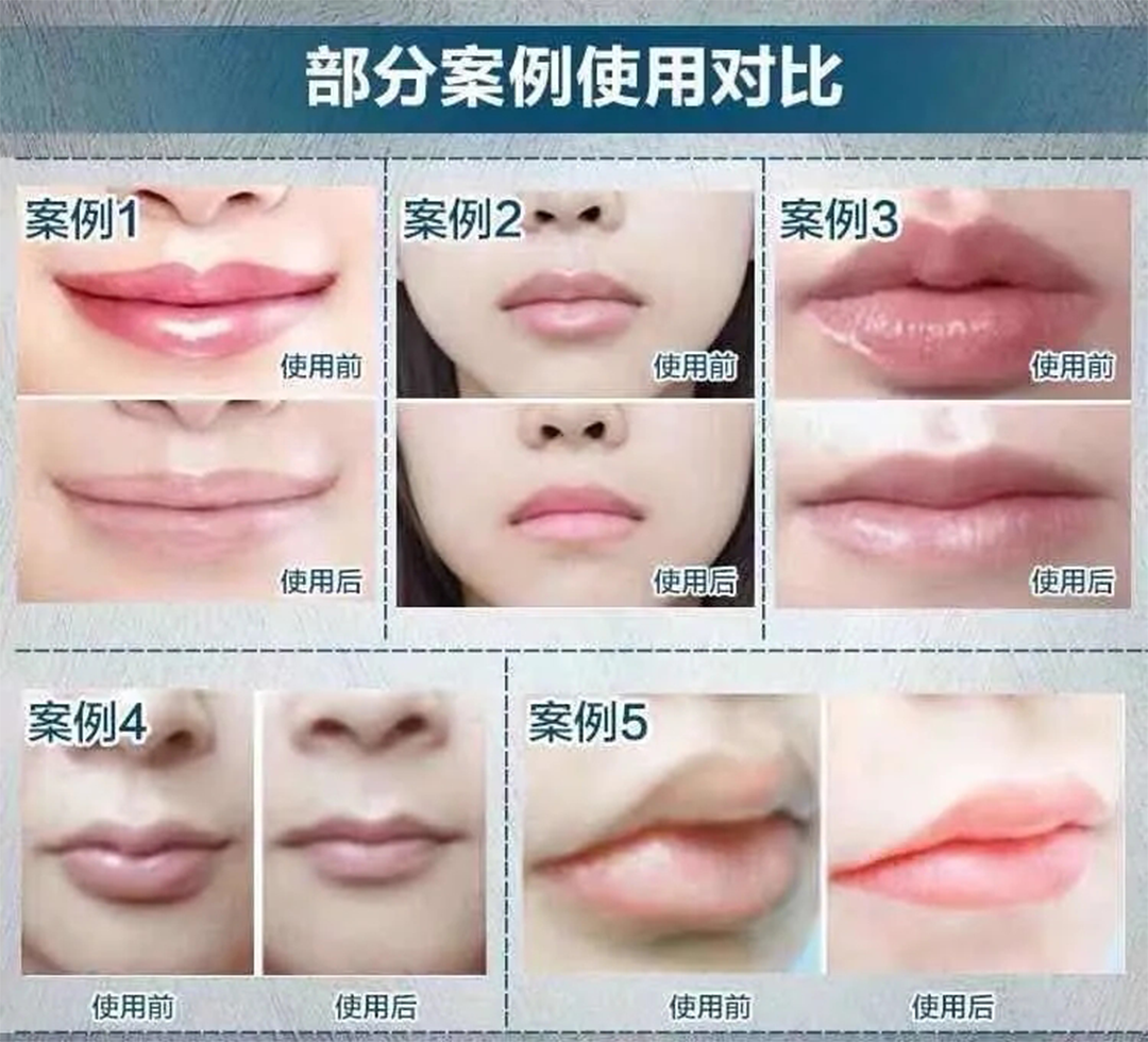 告别香肠嘴无需打针打造自然纤薄双唇厚嘴唇变薄嘴唇薄唇精油女生男生