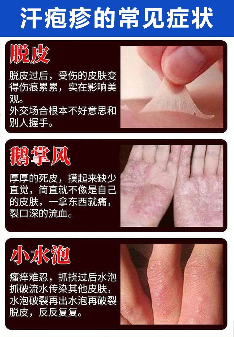 阿胶汗疱疹手上小水泡手痒脱皮干裂手脚开裂膏痒真菌感染止痒膏鹅掌风