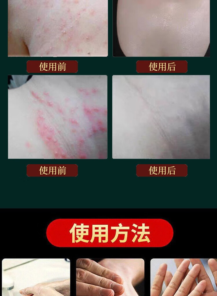 【京东大药房直发】私处瘙痒肛门湿疹肛门瘙痒屁眼痒肛周湿疹肛周瘙痒