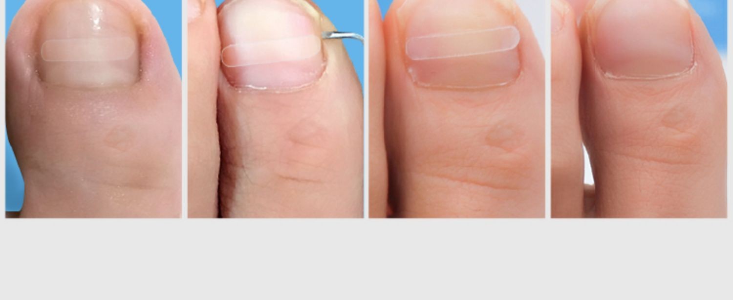 zotoyl正甲贴甲沟嵌甲矫正器沟脚趾甲指甲长肉里纠正炎内嵌非专用加强