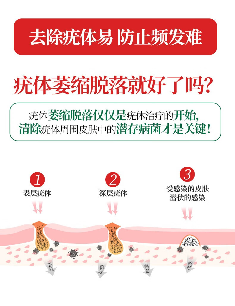 [京选好货]优科利尔 尖锐湿疣湿庞扁平疣去除膏男女肛周鬼臼hs1 一