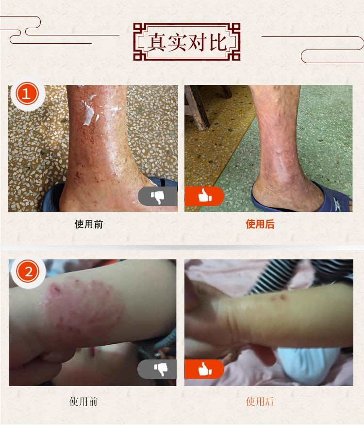 东阿阿胶湿疹专用药膏皮肤瘙痒抑菌止痒膏湿毒真菌感染汗疱疹荨麻疹