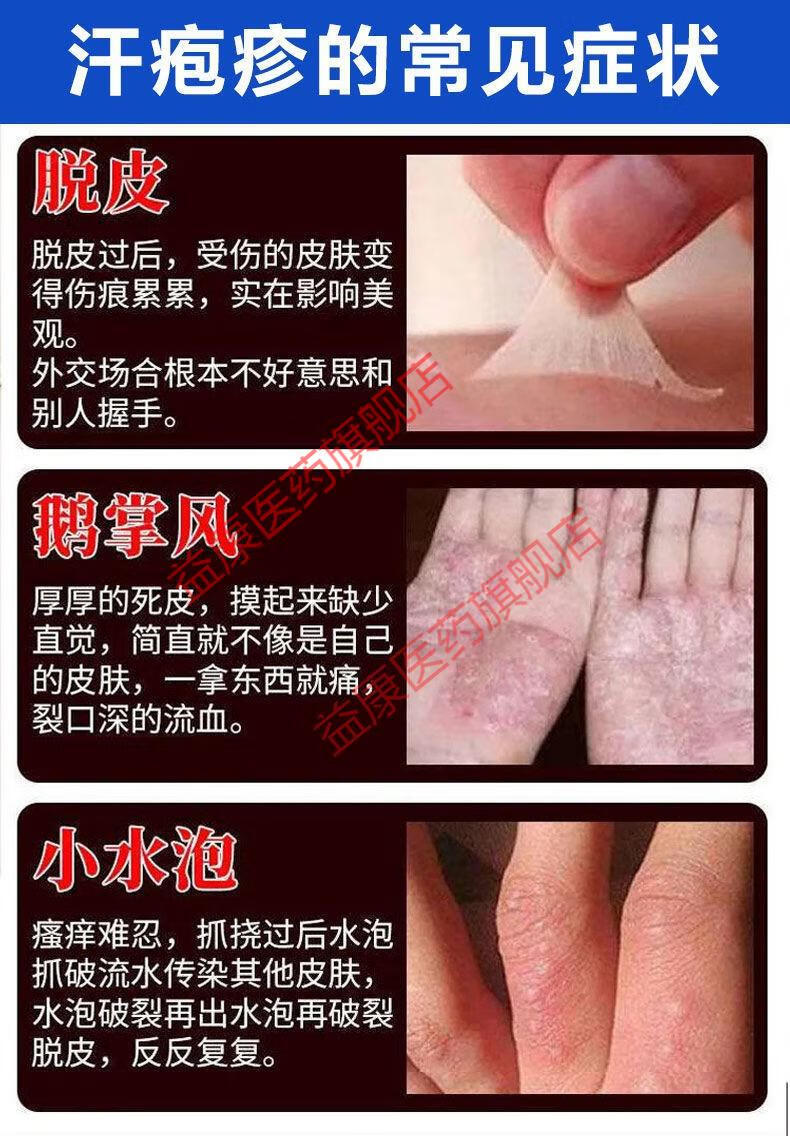 汗疱疹手上小水泡手痒脱皮干裂手脚开裂膏痒真菌感染止痒膏鹅掌风
