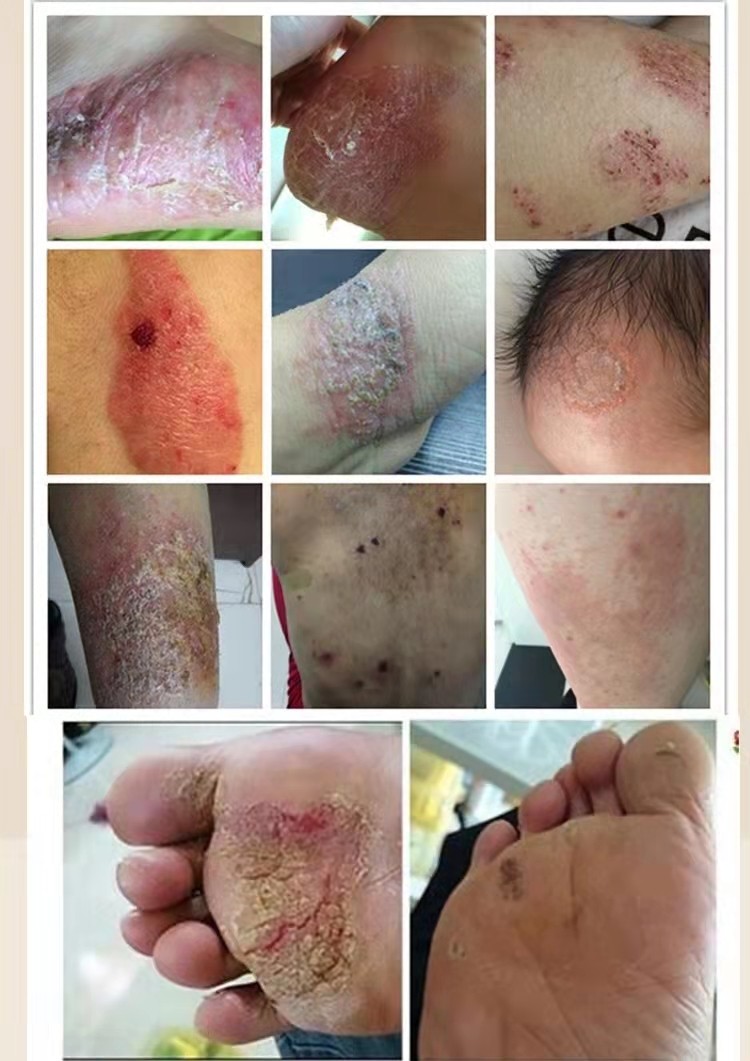 云南七草湿疹膏皮炎汗疱疹皮癣皮肤瘙痒阴囊大腿内侧肛门外阴痒 修复