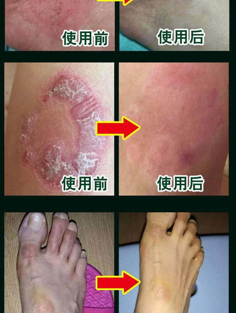 【京东大药房直发】苗药真菌王皮炎湿疹膏牛皮癣皮肤瘙痒止痒皮肤病老