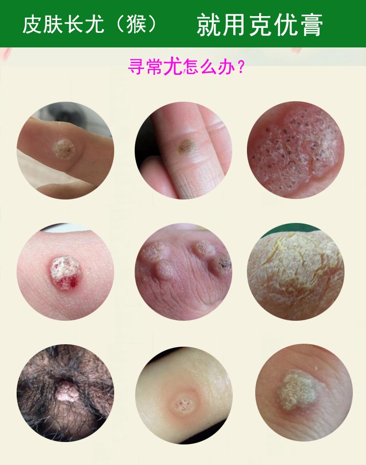 克优膏平灵液霜疣瘊平尖锐湿疣脖子腋下丝状忧疣肉疙瘩皮赘跖忧瘊肉子