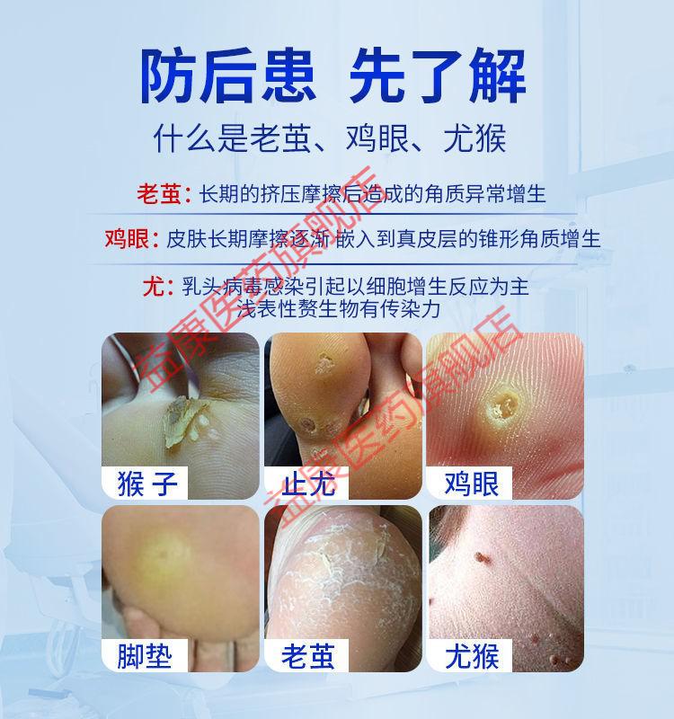 鸡眼膏老茧去除老茧手老茧死皮老茧足部脚掌脚垫硬皮无痛去鸡眼贴 一