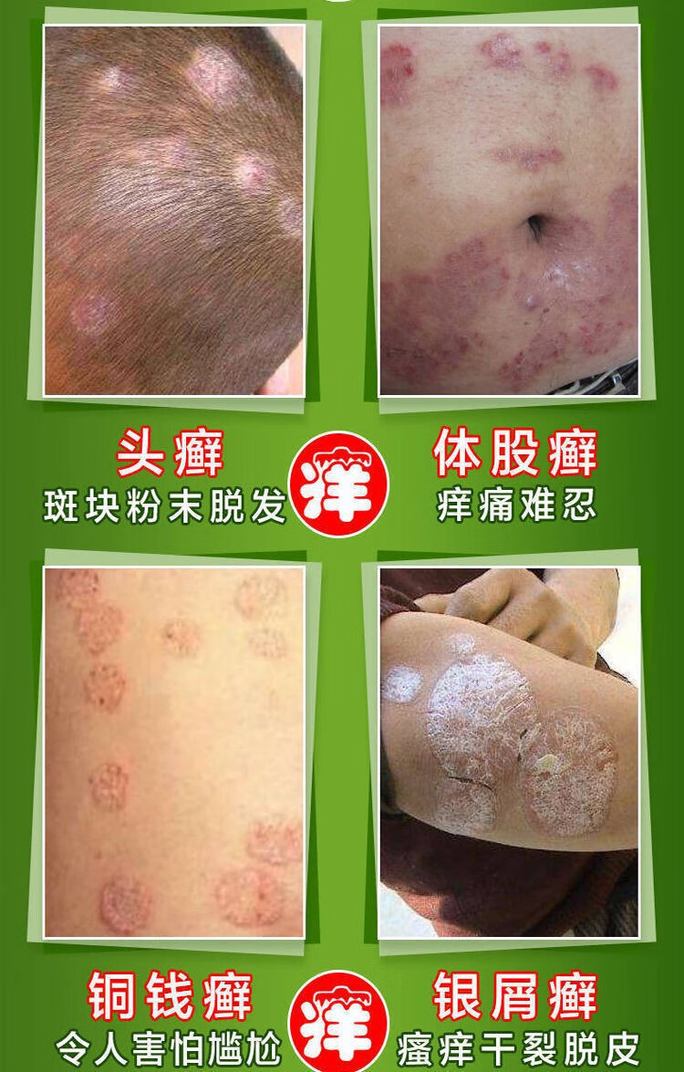 苗家老偏方皮癣牛专用皮肤癣痒灵瘙痒皮炎疹湿癣菌克星癣手足8支重度