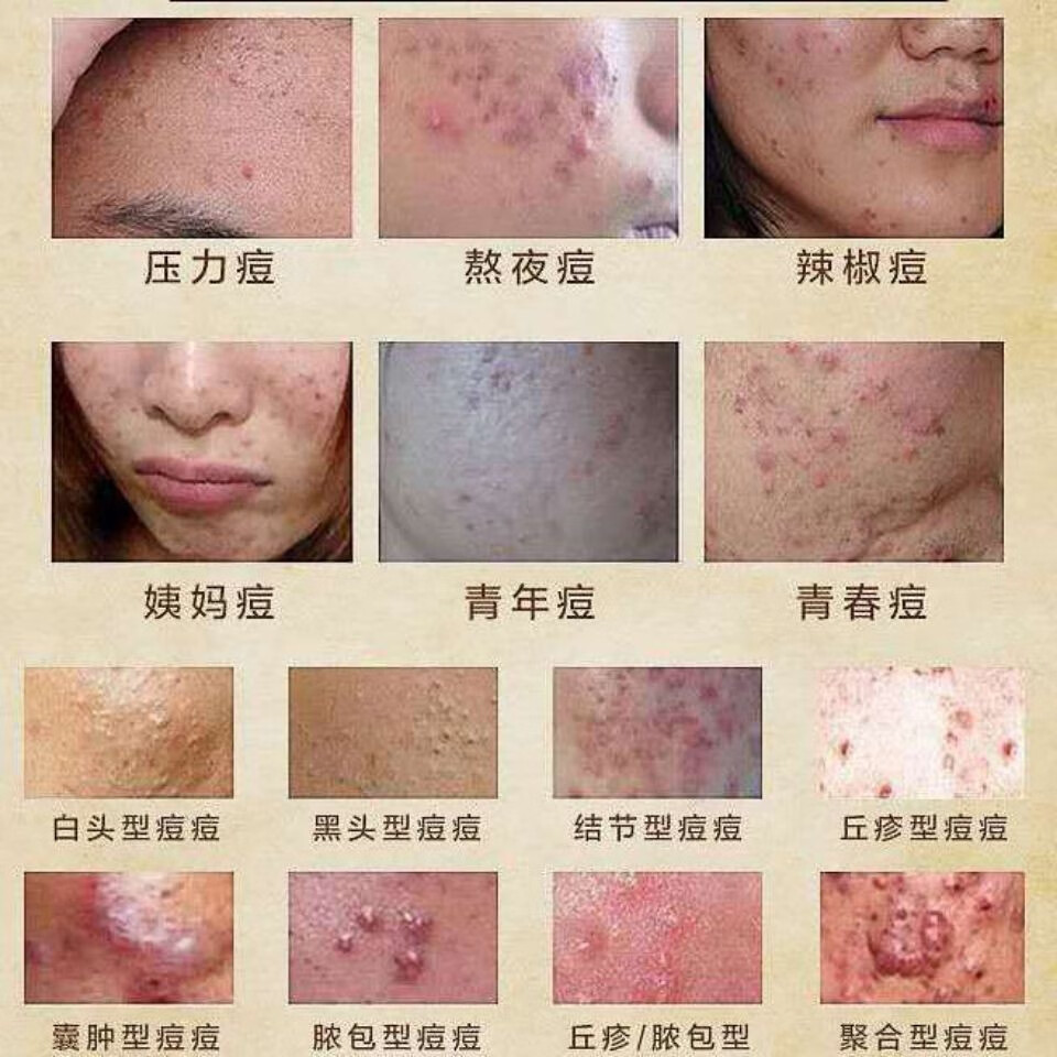 长痘痘用什么药脸上长小疙瘩痘痘黑头粉刺痤疮额头下巴长痘青春痘熬夜