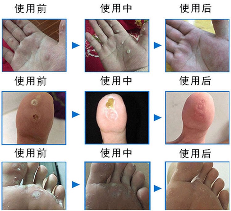 鸡眼贴去疣灵肉刺瘊子趾疣脚肉粒去除手足脚底老茧跖尤死皮鸡眼膏12片
