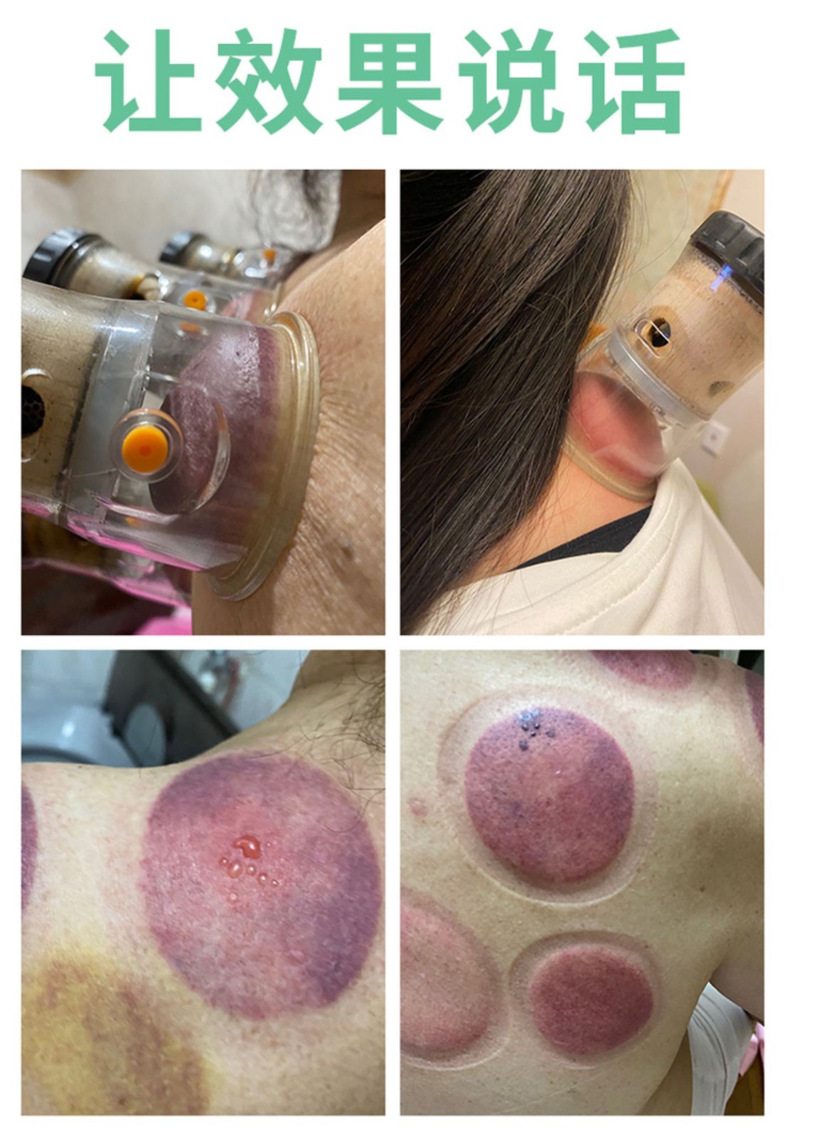 气罐真空拔罐器艾灸家用套装抽气式拔火罐玻璃美容院中医罐srk富林