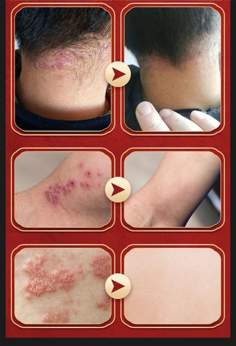 带状疱疹后遗症神经痛特效疱疹清病毒蛇药胆疮缠腰龙