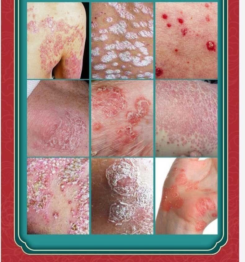 牛皮癣银屑病专用苗特效止痒药膏皮肤瘙痒外用治神经性皮炎去根除