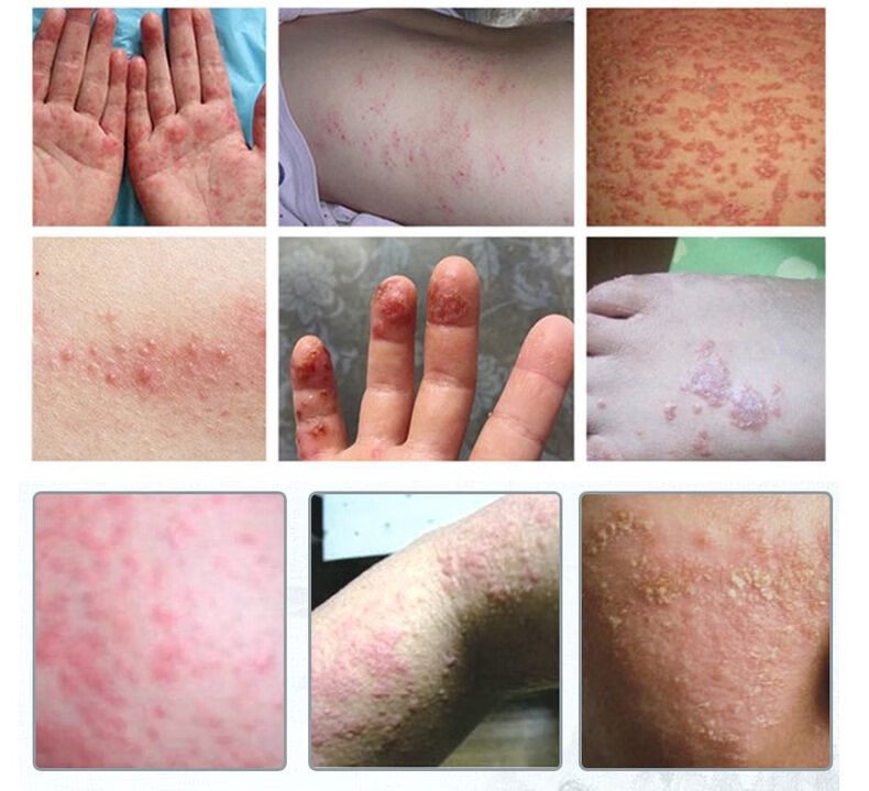 【京东健康大药房】黄芪真菌王皮炎湿疹专用牛皮癣银屑病体癣头癣手