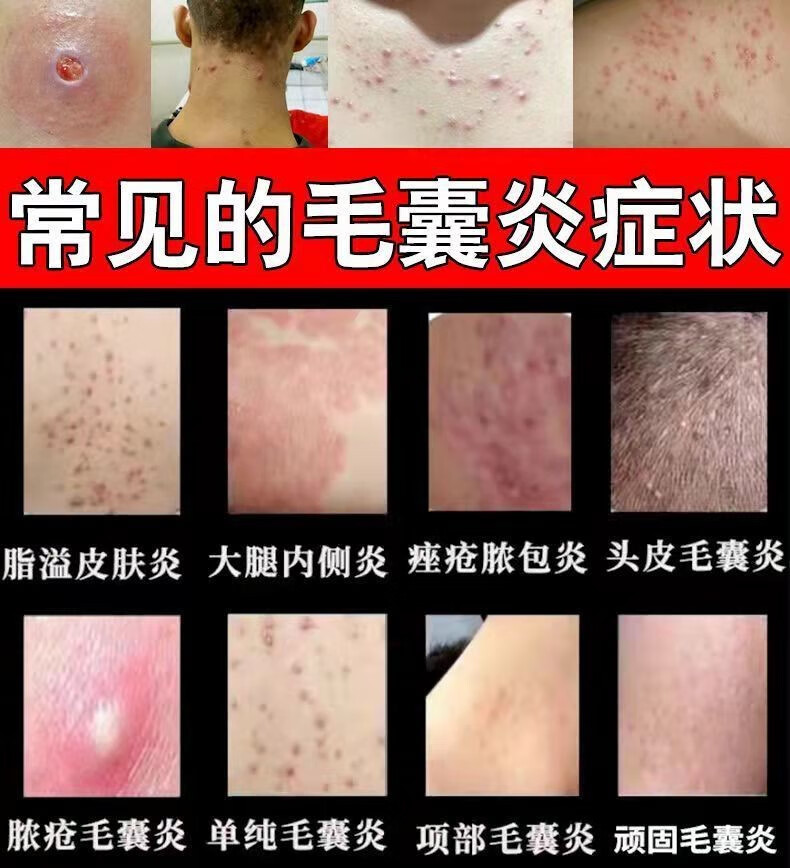 药房直发毛囊炎药专用头皮喷剂后背祛痘喷雾胸部头部疙瘩痘痘脓包马拉