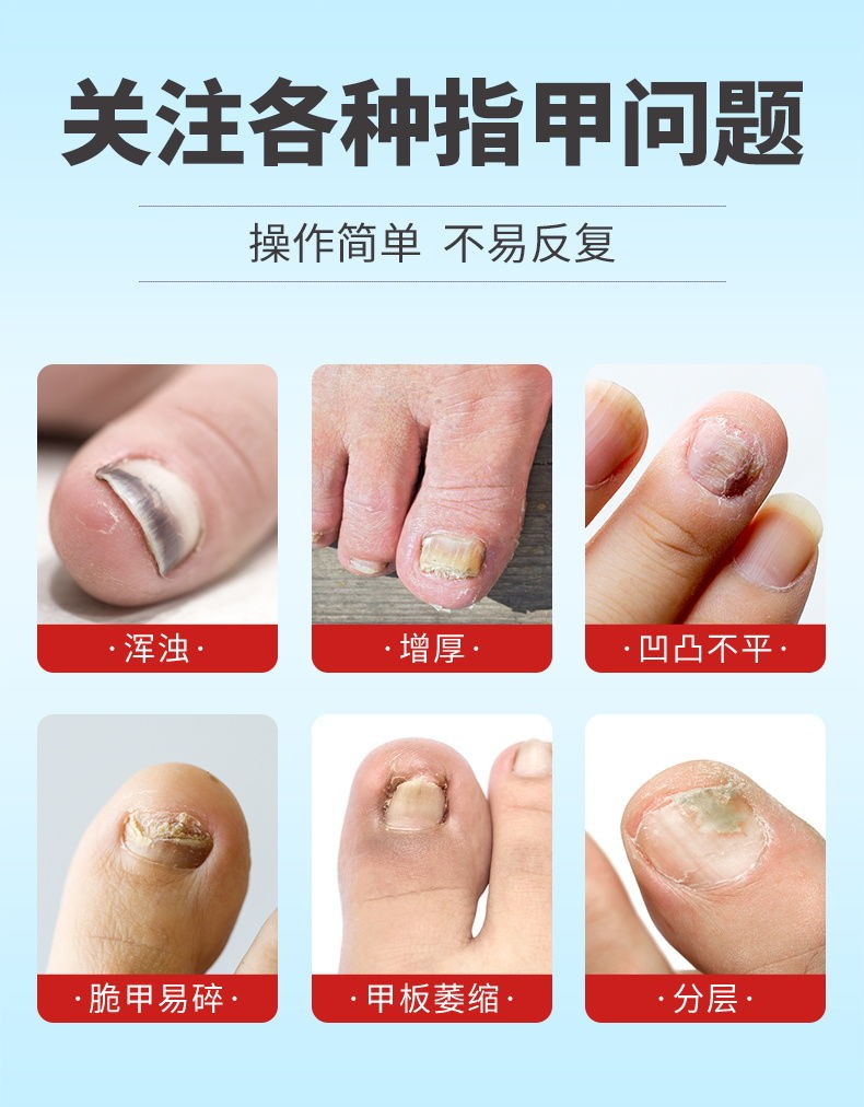 云南本草灰指甲专用液亮甲沟炎灰甲增厚软指甲膏冰醋酸抑菌液非药