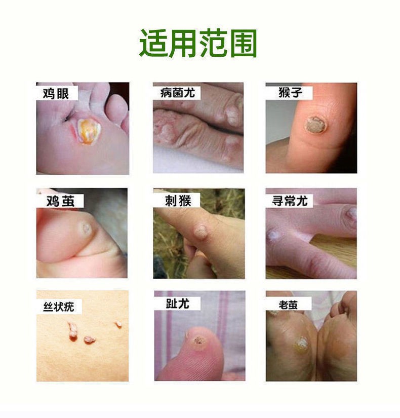 【药房直发】克疣液去猴子疣刺瘊疣祛丝状尤去除脖子小肉粒去鸡眼神器