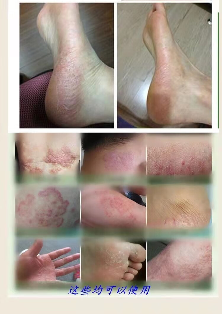 云南七草湿疹膏皮炎汗疱疹皮癣皮肤瘙痒阴囊大腿内侧肛门外阴痒 修复