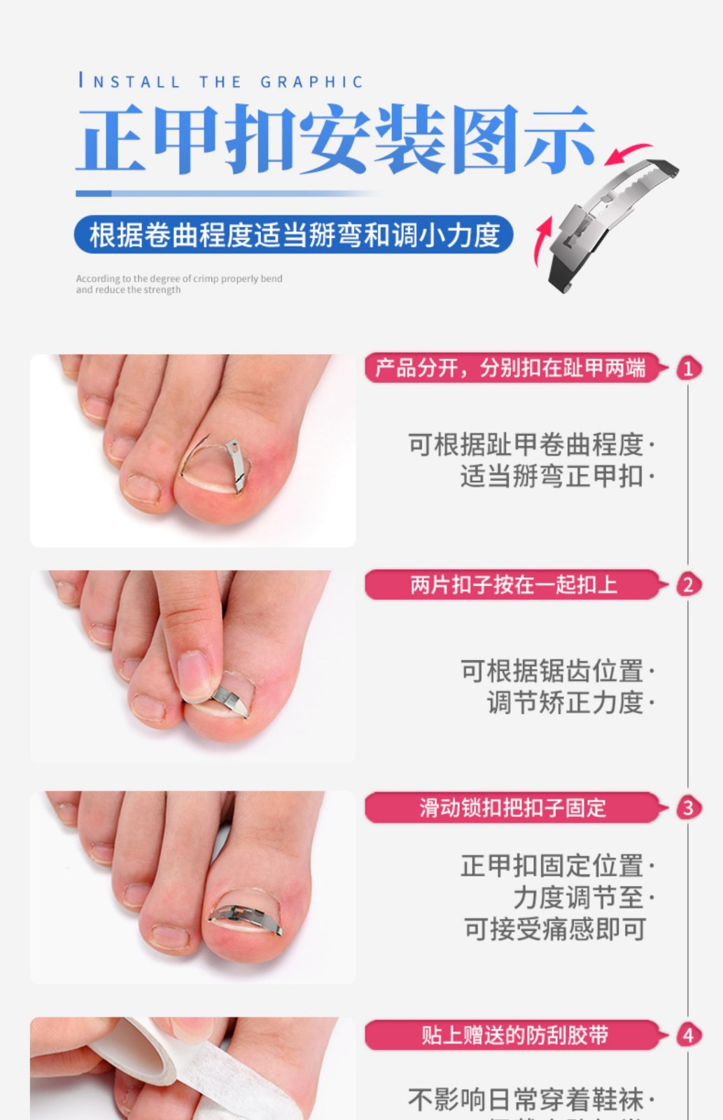 zotoyl甲沟矫正器贴嵌甲正甲扣脚趾甲贴片长肉里修纠正指甲卷拉拉炎正
