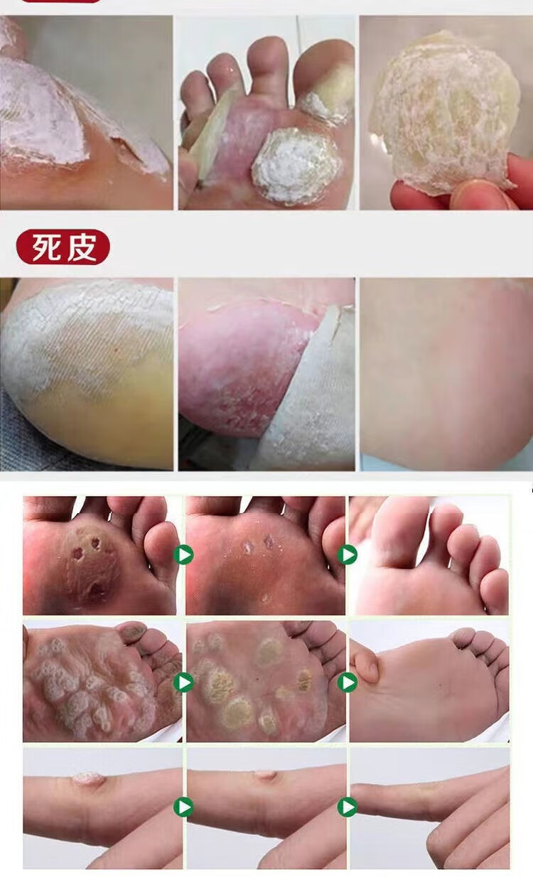 鸡茧膏特效去鸡眼专用老茧脚钉去除跖疣瘊子鱼鳞刺瘊脚垫肉刺自然脱落