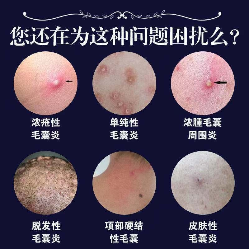 反复毛囊炎头部背部脸部脓包疮痤疮痘痘疙瘩毛囊堵塞甲硝唑凝胶.