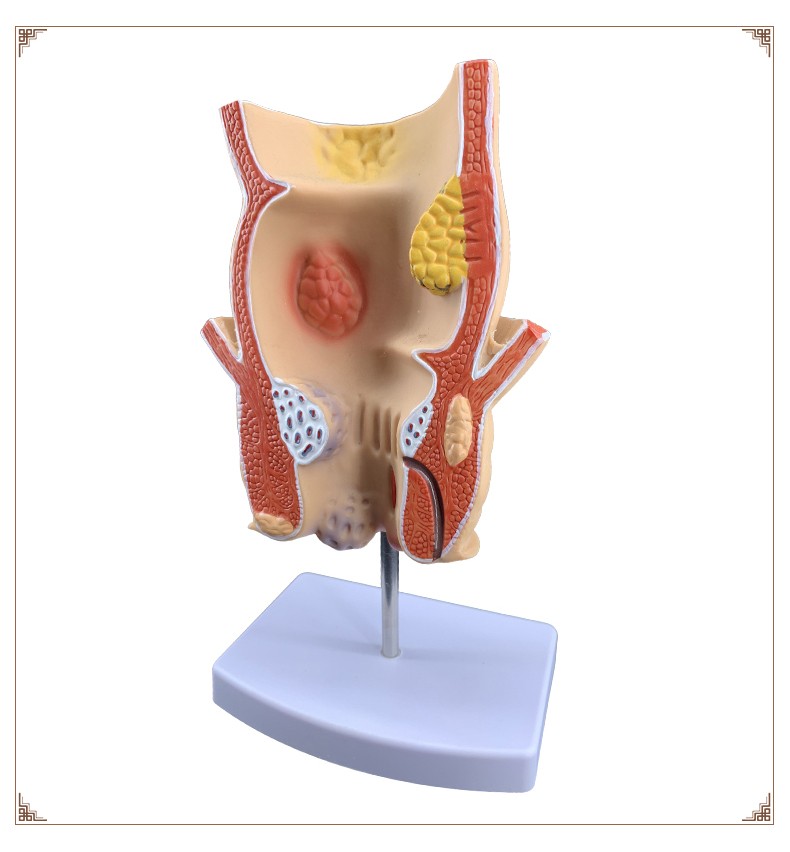 卓越 直肠痔疮病变模型痔疮内外解剖 肛门肛肠科大肠直肠病理教学模型