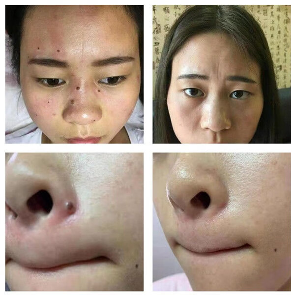 点痣膏面部无痕永久身体痣贴去黑痣痦子黑点刺猴去痣神器除痣灵膏稀释