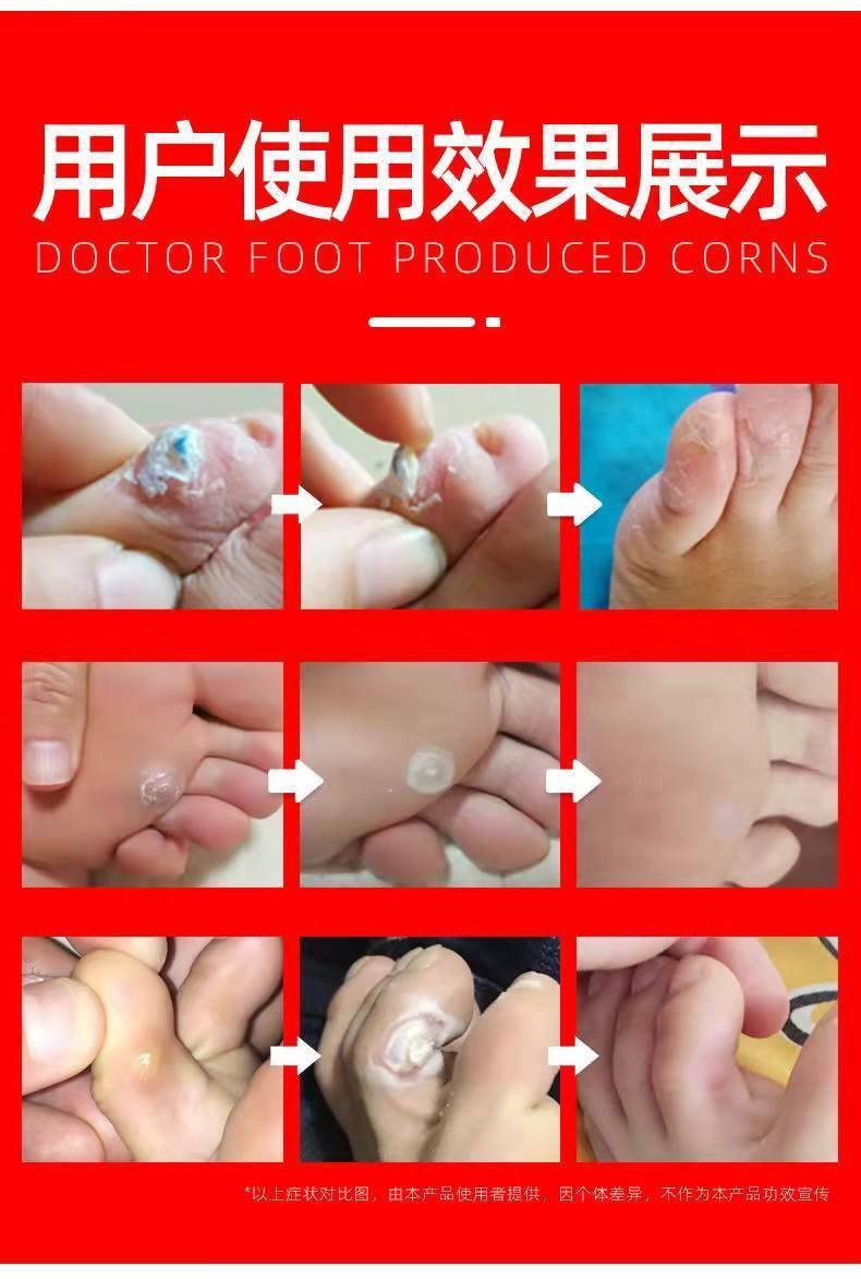 去鸡眼贴鸡眼膏贴去除鸡眼肉刺老茧脚垫脚丁猴子跖疣鸡眼专用 简装20