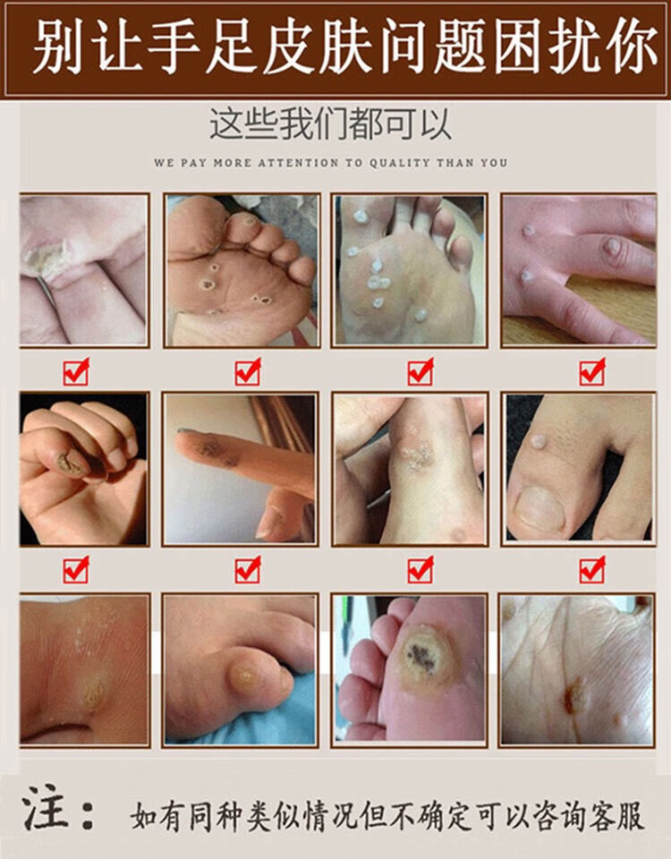 鸡眼贴去疣灵肉刺瘊子趾疣脚肉粒去除手足脚底老茧跖尤死皮鸡眼膏12片