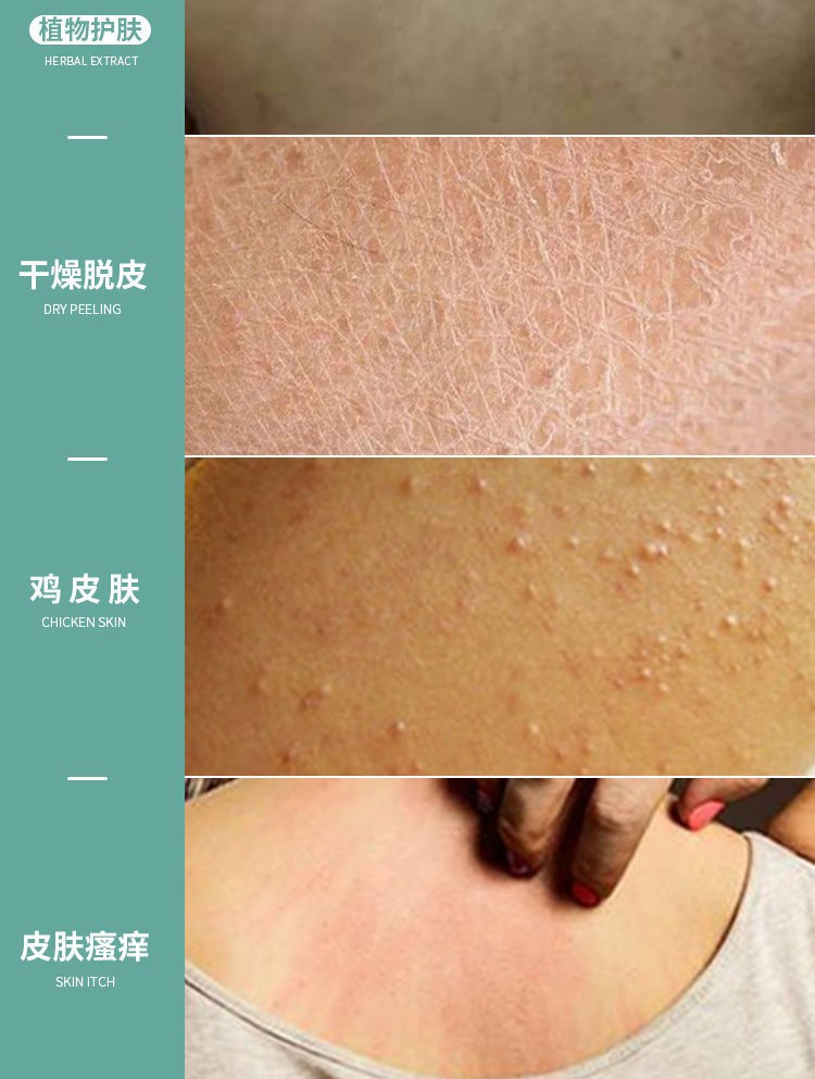 【京东药房直发】阴囊湿疹止痒去根成人艾草苦参沐浴露皮肤瘙痒全身痒