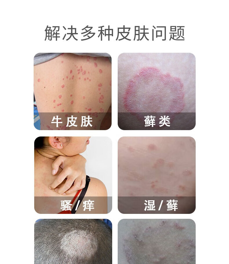 紫花地丁透皮抑菌膏疹湿大腿内侧真菌感染癣股成人阴囊肛门痒皮牛疹手