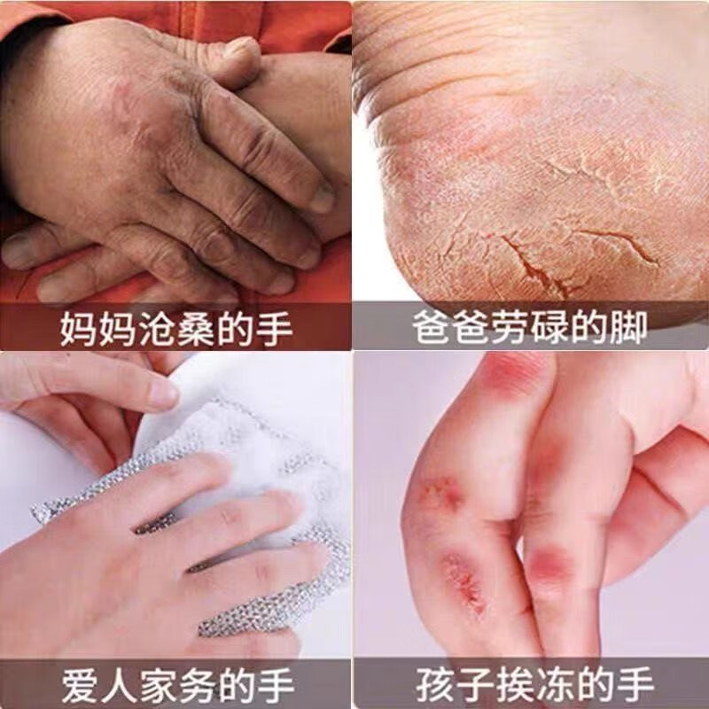 冻疮膏去裉防冻消肿男女防冻伤耳朵手脚防干裂脸护手霜001倍功效护手
