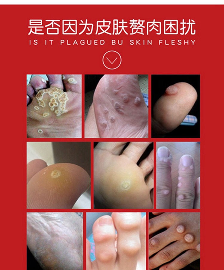 鸡眼贴去疣灵肉刺瘊子趾疣脚肉粒去除手足脚底老茧跖尤死皮鸡眼膏12片