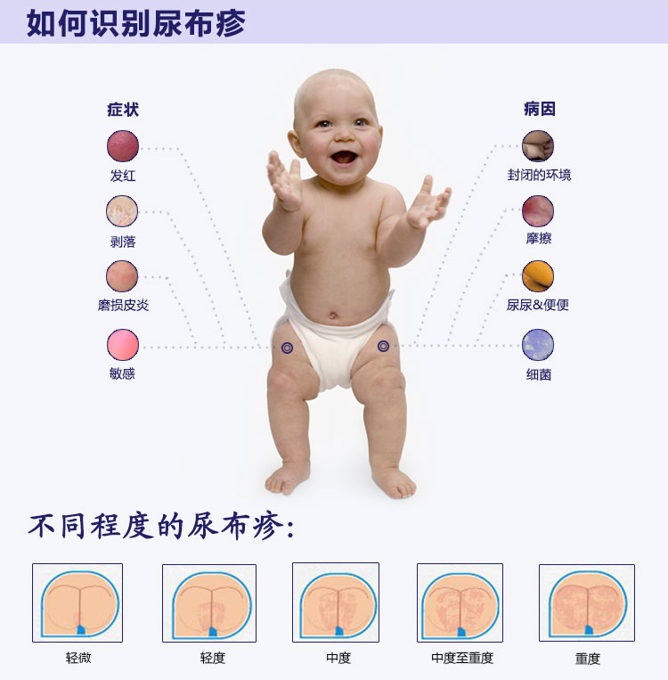 美国desitin 护臀膏湿疹膏宝宝湿疹尿布疹 113g