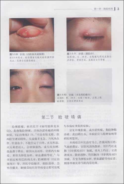 针眼,病名见于《诸病源候论》.