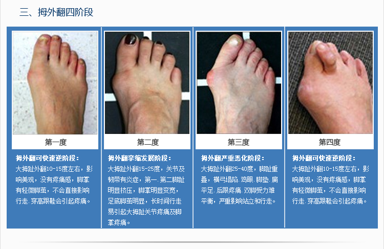 【材 质】100%医用硅胶 【适 应】用于拇外翻脚趾分离,重叠趾,鸡眼的