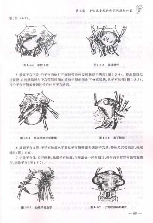 巴氏腺造口术缝针图片图片