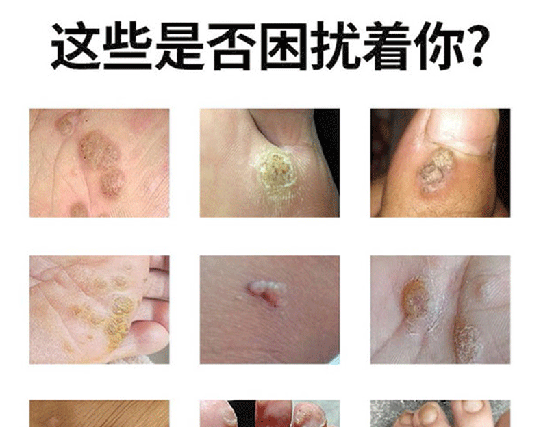 众乐康健传染性软疣面部疣扁平手足部鸡眼hpv疣必治老茧除跖u瘊皮子刺