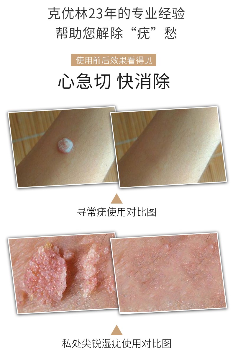 普林克优林尖锐疣湿疣男女性肛周私处hpv丝状扁平疣去疣液膏 hk 私处