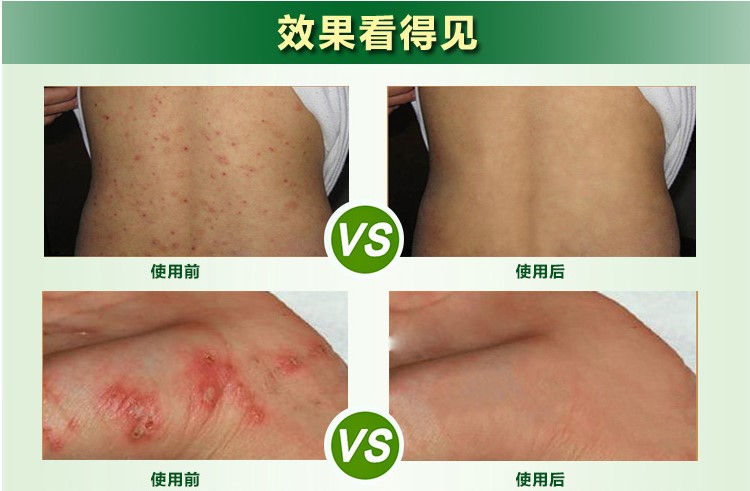 玺之馆疥灵霜虱宁康阴虱乐宁成人喷剂虱尔乐头虱子一扫光玉锦诗乐净